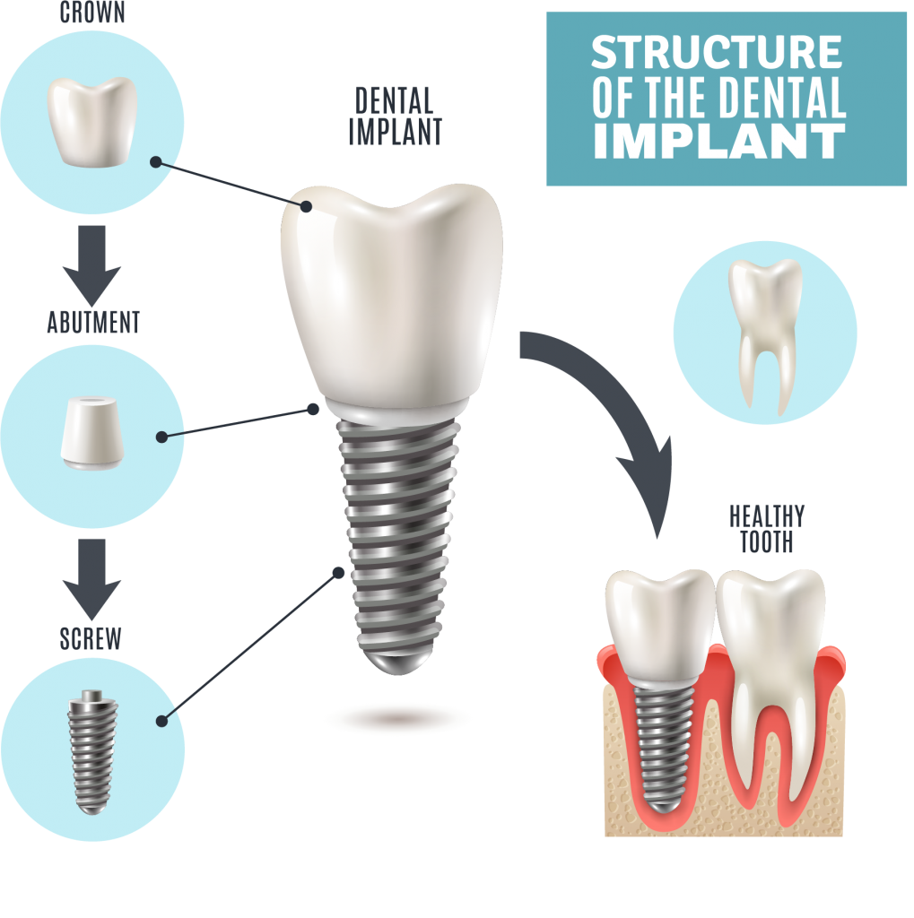 ส่วนประกอบ รากเทียม Implant - คลินิกทันตกรรมไวท์ทีธ โดยทีนตแพทย์เฉพาะทางทันตกรรม