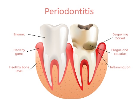 โรคเหงือกอักเสบ (Periodontics) - White Teeth dental Clinic