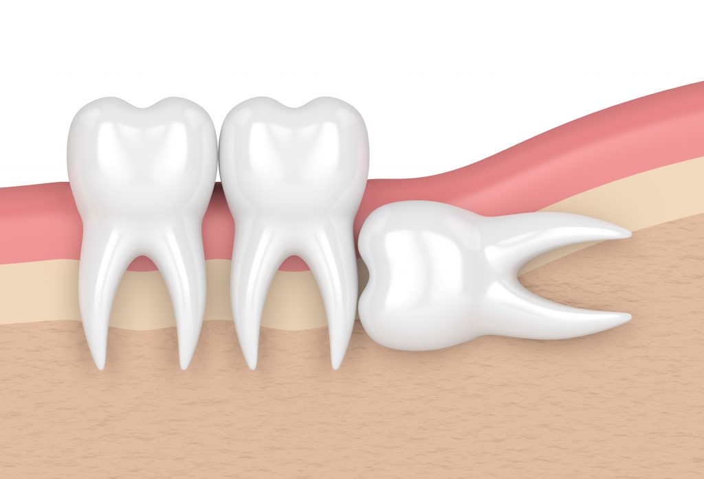 ถอนฟันคุด ผ่าตัดฟันคุด- Teeth Extraction, Wisdom teeth removal 