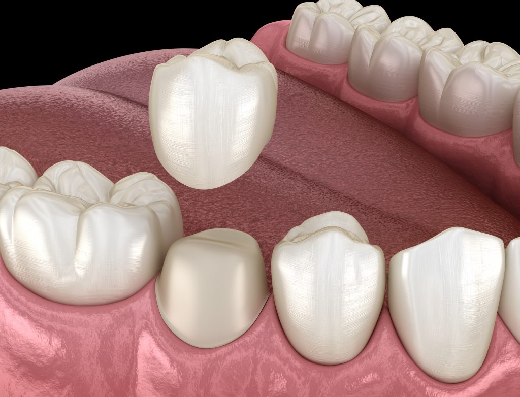 การครอบฟัน - Dental Crown Treatment