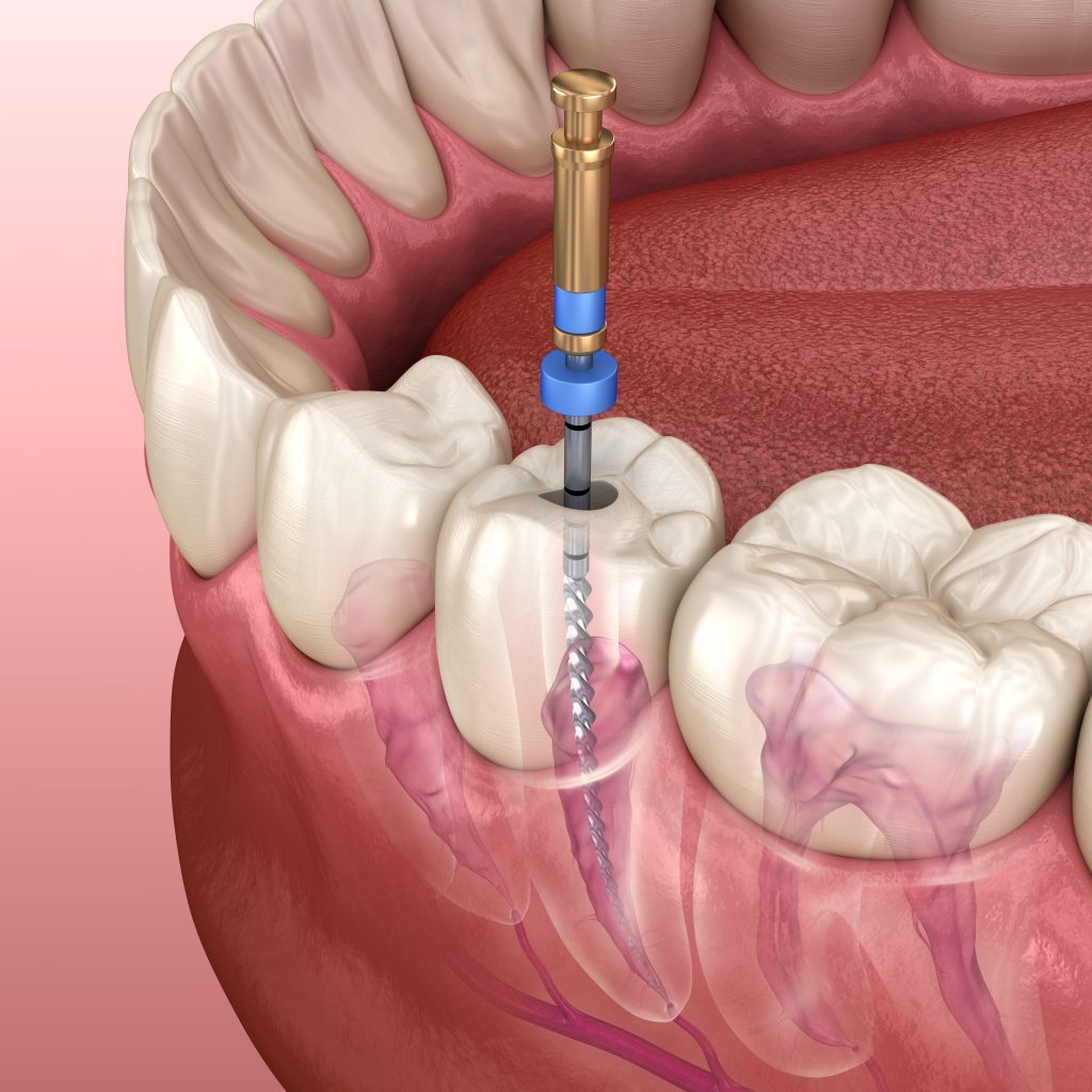 รักษารากฟัน-Endondontic -Root Canal Treatment (RCT)