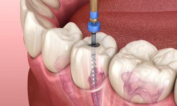 รักษารากฟัน-Endondontic -Root Canal Treatment (RCT)
