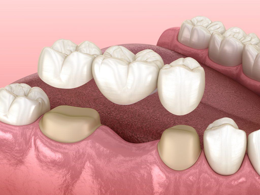 Dentures : สะพานฟัน (Dental bridge) - White Teeth Dental Clinic 