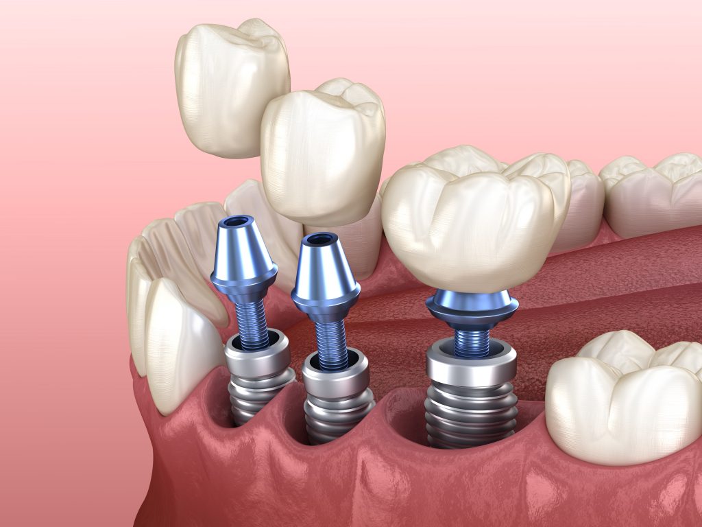 รากเทียม Implant- คลินิกทันตกรรมไวท์ทีธ