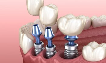 รากเทียม Implant - White Teeth Dental Clinic