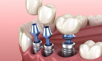 รากเทียม Implant- คลินิกทันตกรรมไวท์ทีธ