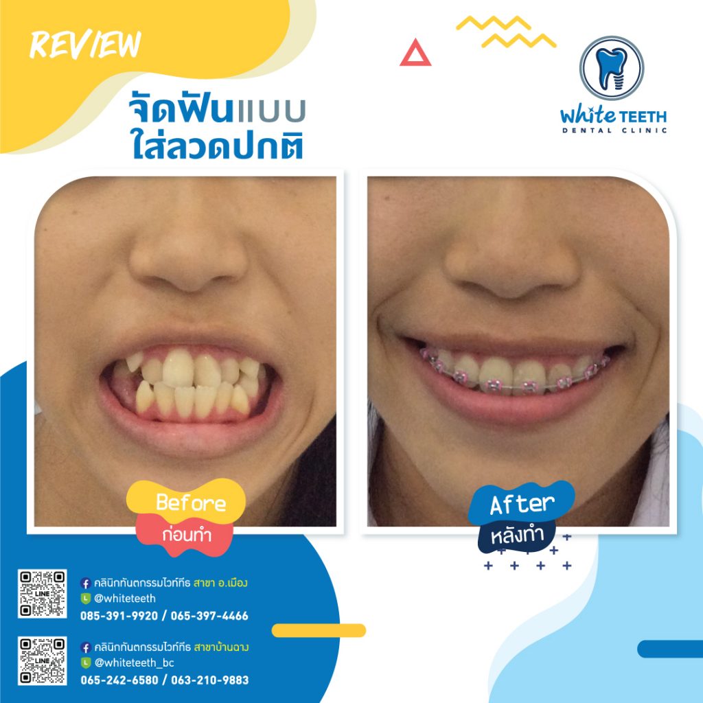 รีวิวจัดฟัน - Orthodontic Review_06