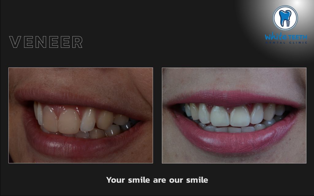 White Teeth-Veneer01