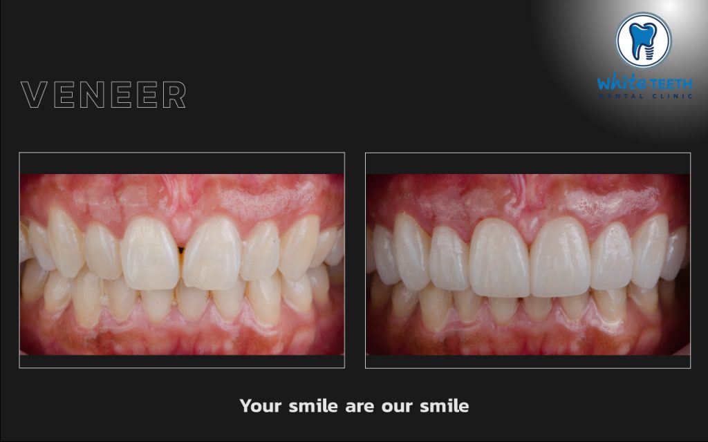 White Teeth-Veneer03