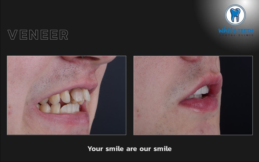 White Teeth-Veneer04