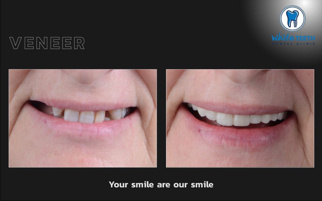 White Teeth-Veneer06