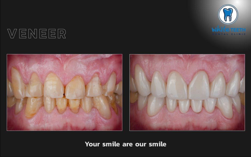 รีวิววีเนียร์ - Veneer Review_08 - คลินิกทันตกรรมไวท์ทีธ - White Teeth Dental Clinic