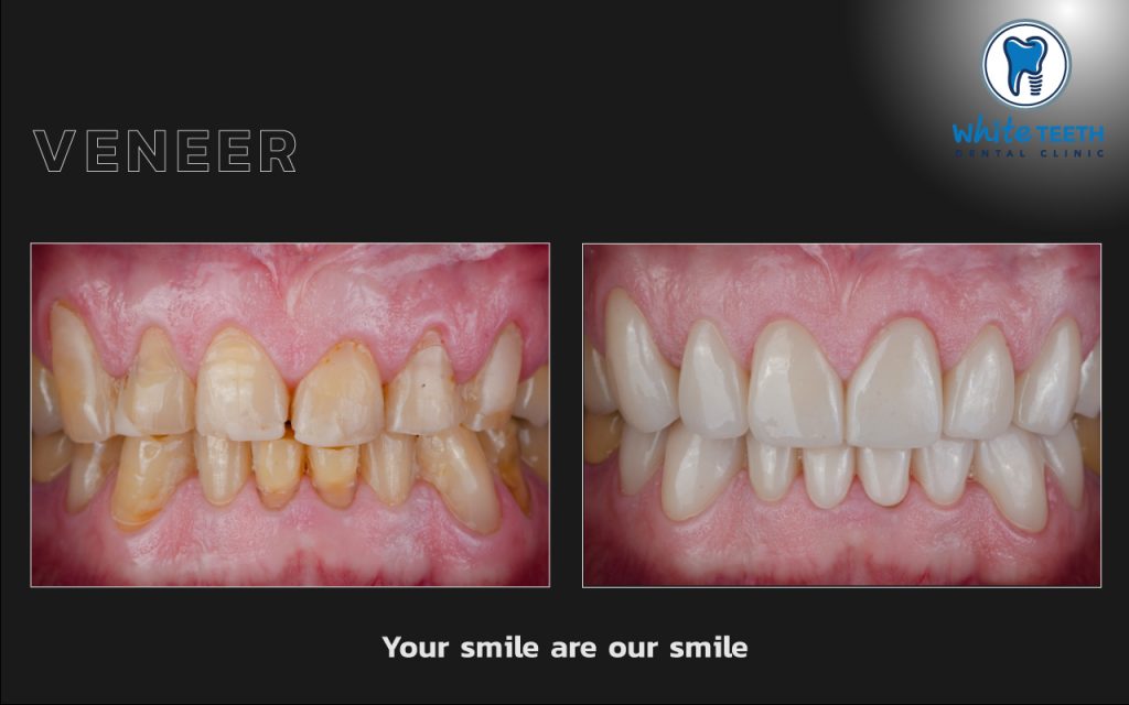 White Teeth-Veneer09