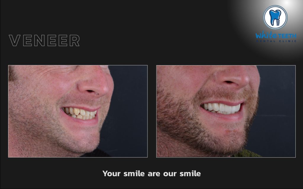 White Teeth-Veneer10