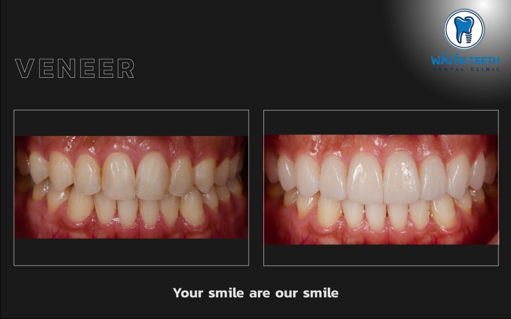 White Teeth-Veneer12