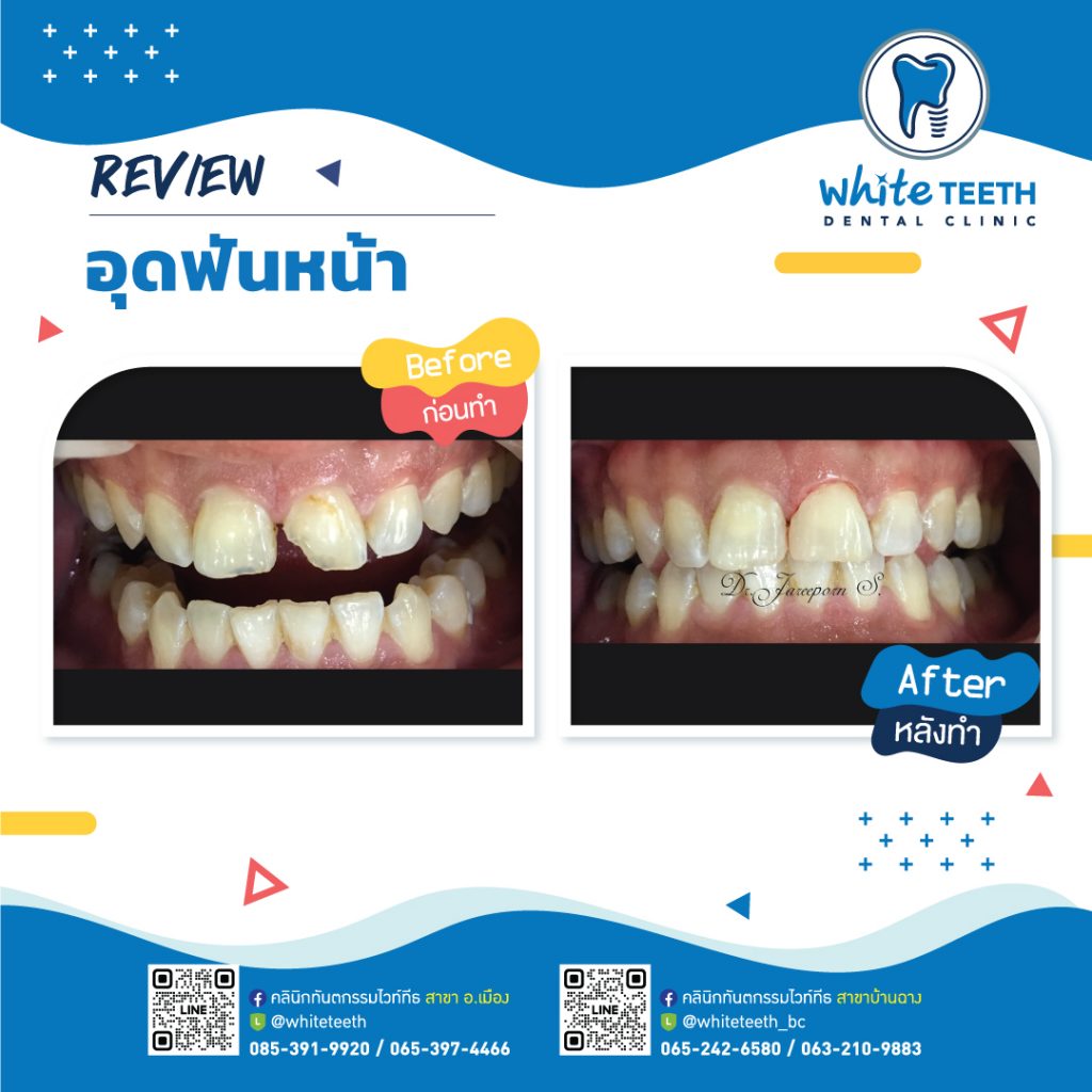 รีวิววอุดฟันหน้า-Front Filling Review_02