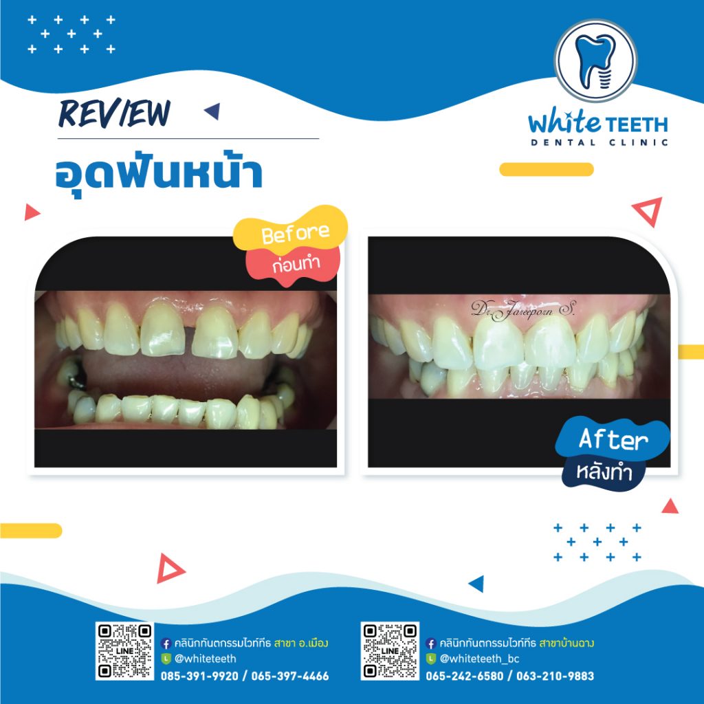 รีวิววอุดฟันหน้า-Front Filling Review_03