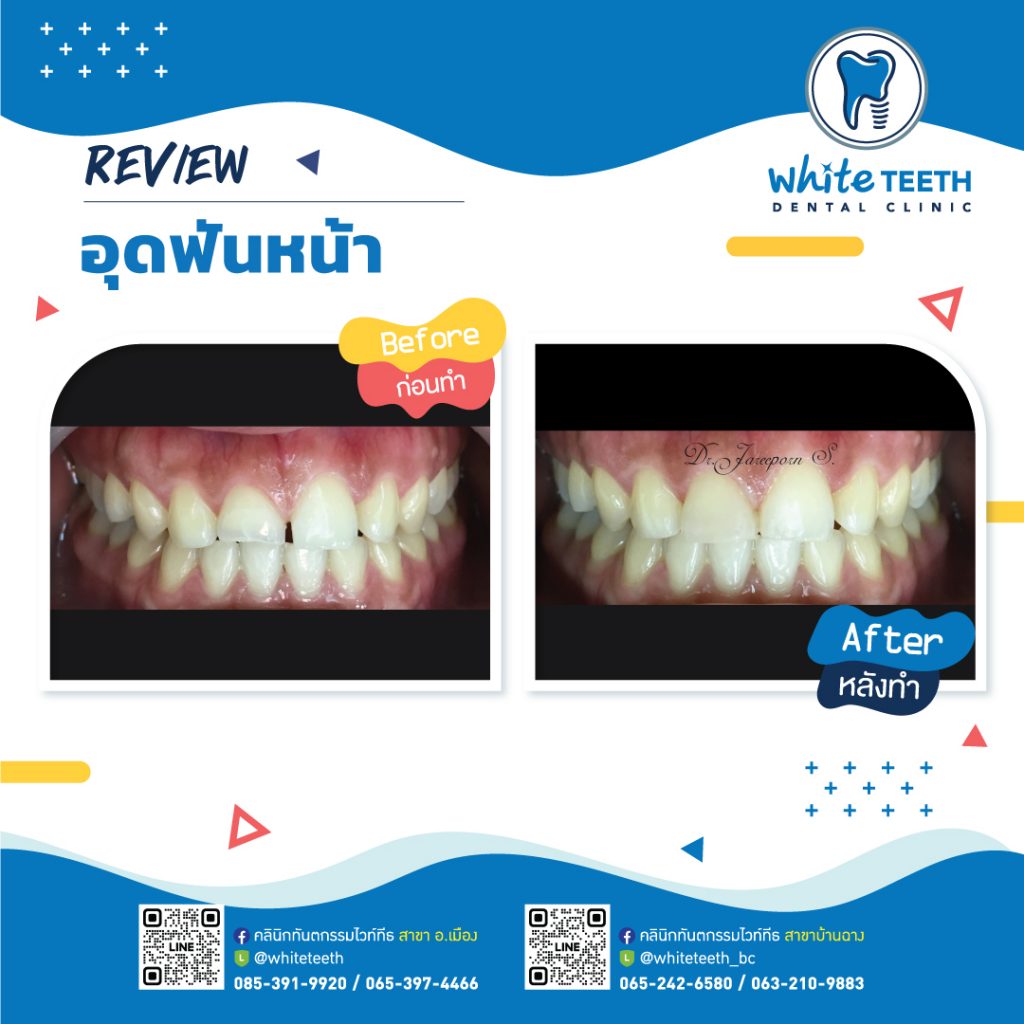 รีวิววอุดฟันหน้า-Front Filling Review_05