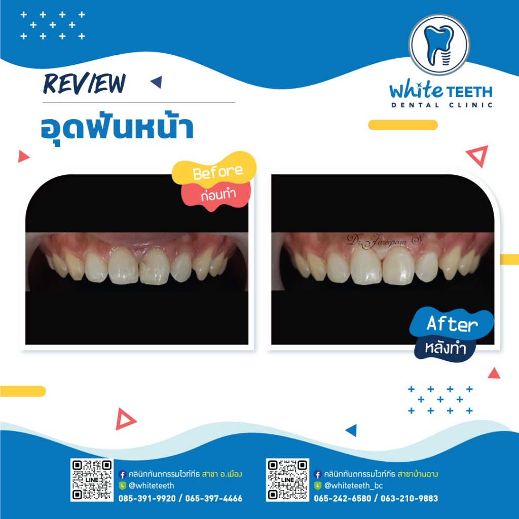 รีวิววอุดฟันหน้า-Front Filling Review_06