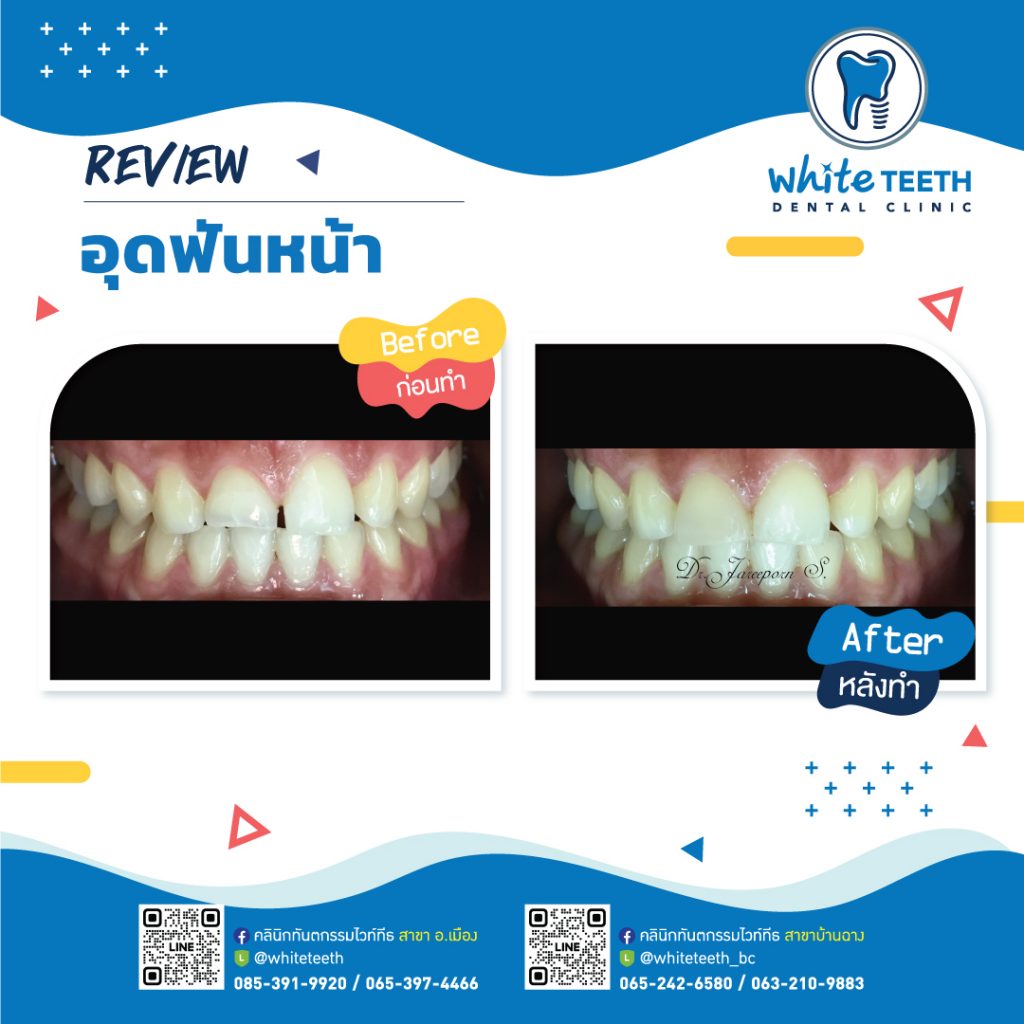 รีวิววอุดฟันหน้า-Front Filling Review_07