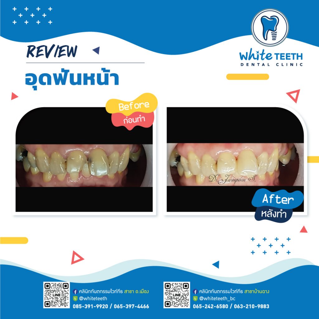 รีวิววอุดฟันหน้า-Front Filling Review_08