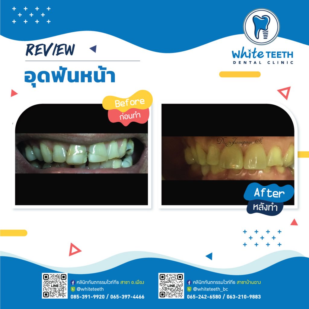 รีวิววอุดฟันหน้า-Front Filling Review_09