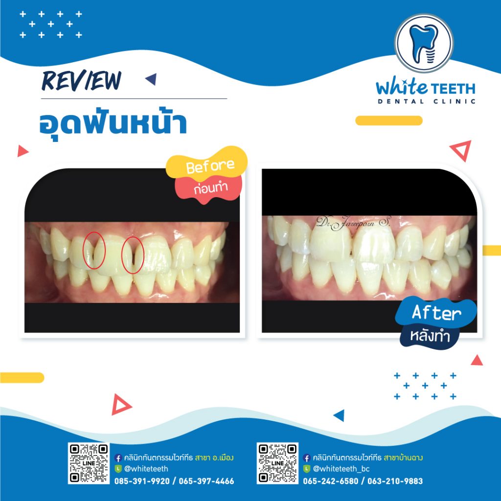 รีวิววอุดฟันหน้า-Front Filling Review_10