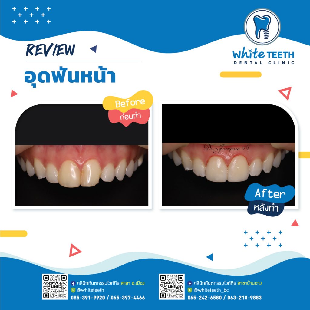 รีวิววอุดฟันหน้า-Front Filling Review_12