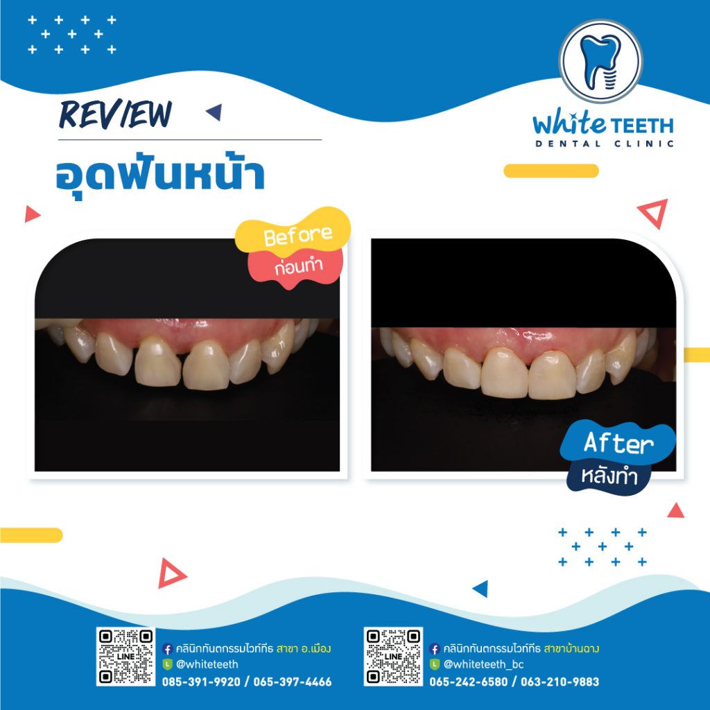 รีวิววอุดฟันหน้า-Front Filling Review_14