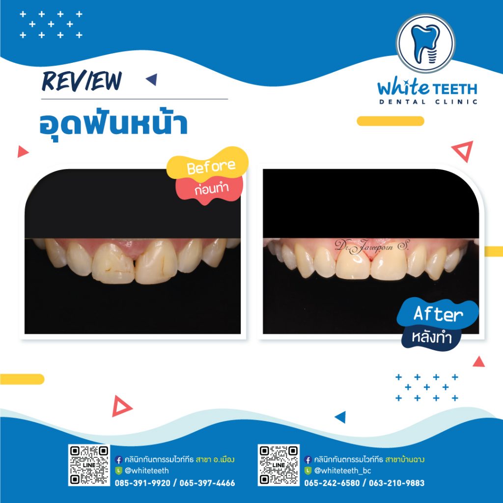 รีวิววอุดฟันหน้า-Front Filling Review_15