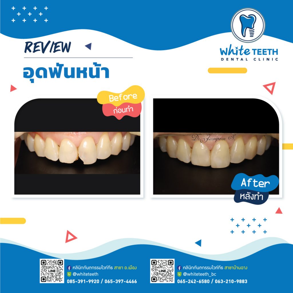 รีวิววอุดฟันหน้า-Front Filling Review_16