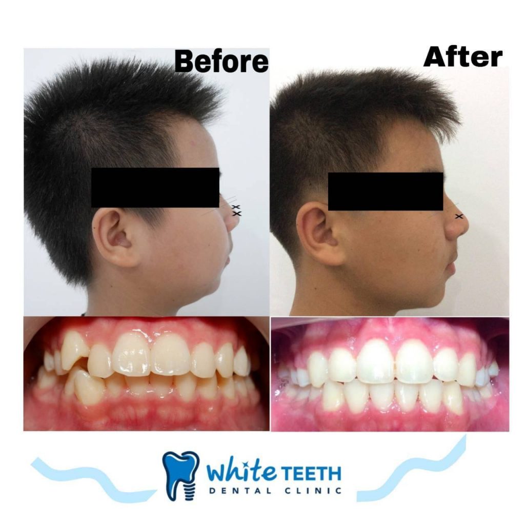 White Teeth-จัดฟัน01