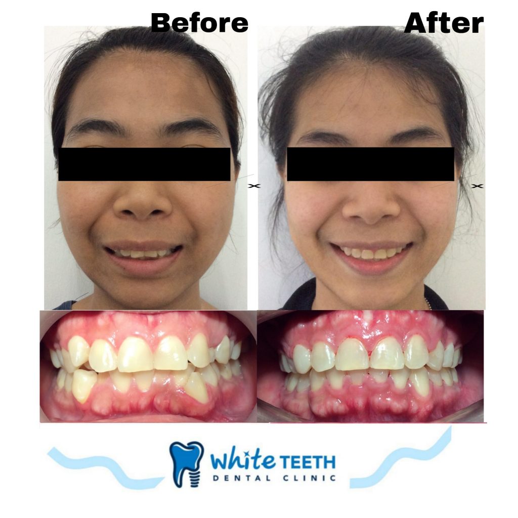 รีวิวจัดฟัน - Orthodontic Review_02