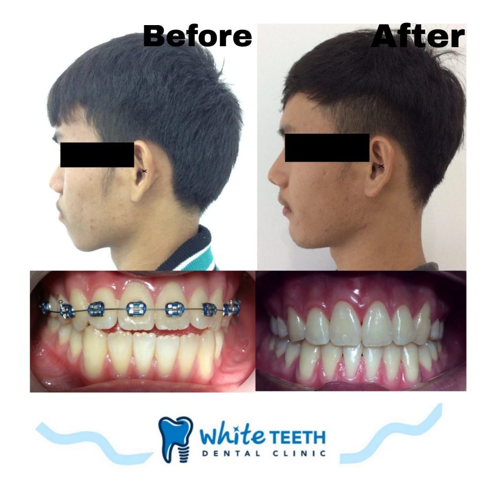 รีวิวจัดฟัน - Orthodontic Review_05