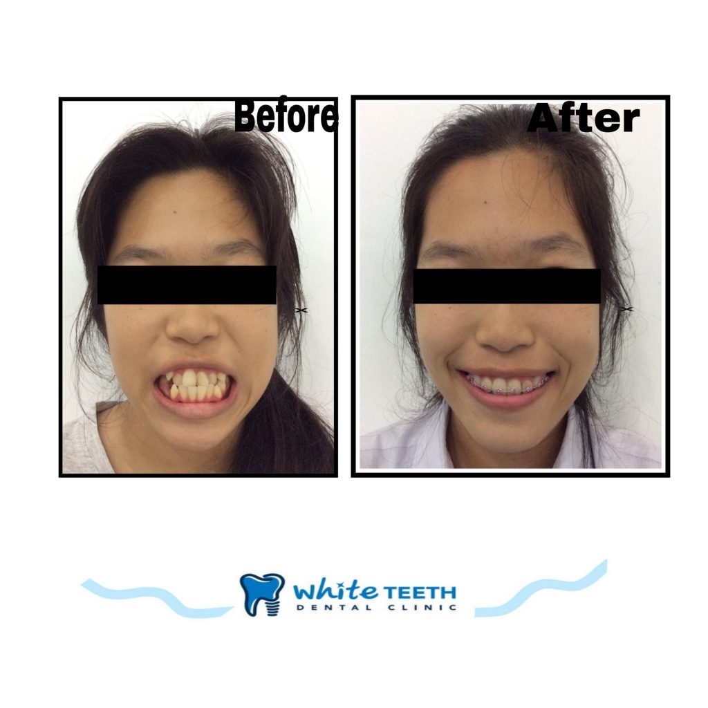 รีวิวจัดฟัน - Orthodontic Review_04