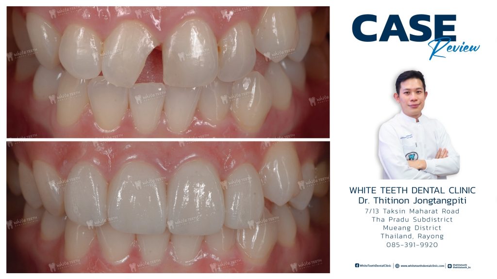รีวิววีเนียร์ - Veneer Review_22 - คลินิกทันตกรรมไวท์ทีธ - White Teeth Dental Clinic