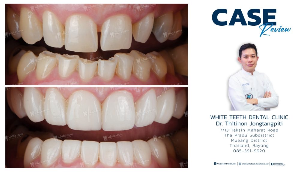 รีวิววีเนียร์ - Veneer Review_24 - คลินิกทันตกรรมไวท์ทีธ - White Teeth Dental Clinic