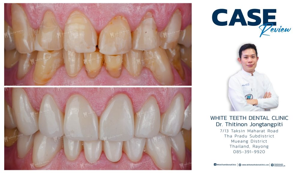 รีวิววีเนียร์ - Veneer Review_26 - คลินิกทันตกรรมไวท์ทีธ - White Teeth Dental Clinic