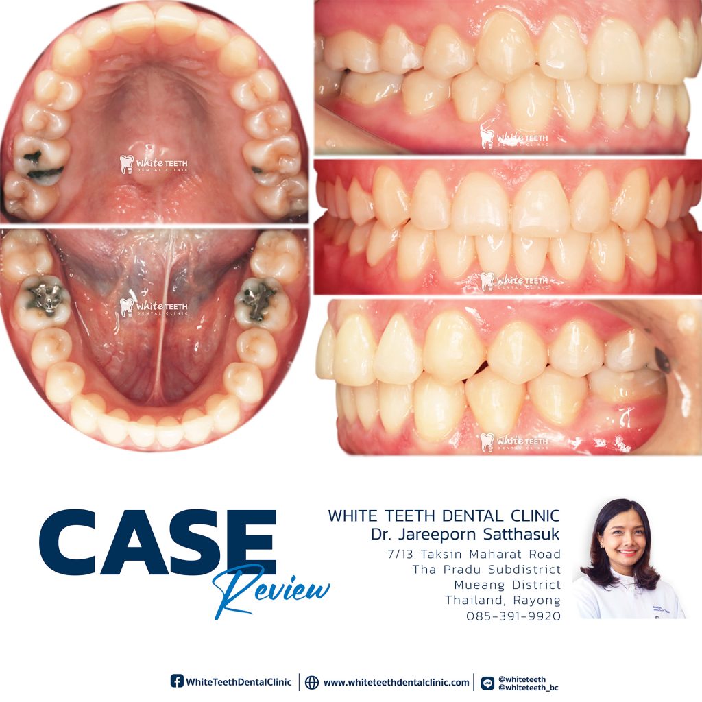 รีวิวจัดฟัน - Orthodontic Review_07