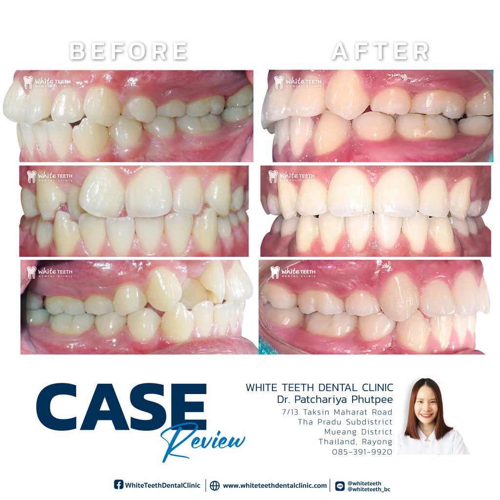 รีวิวจัดฟัน - Orthodontic Review_09