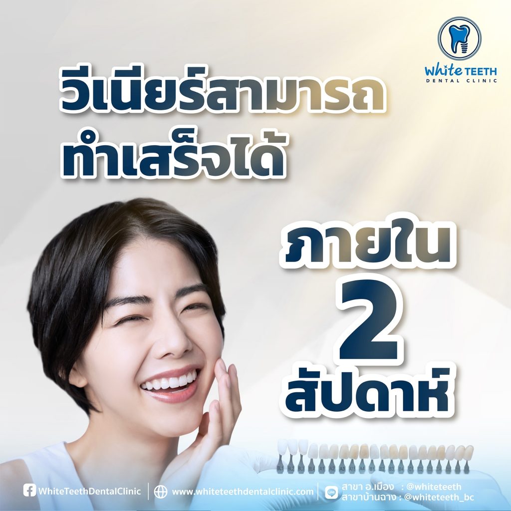 Veneer Procedure-ขั้นตอนการทำวีเนียร์_02 - คลินิกทันตกรรมไวท์ทีธ - White Teeth Dental Clinic