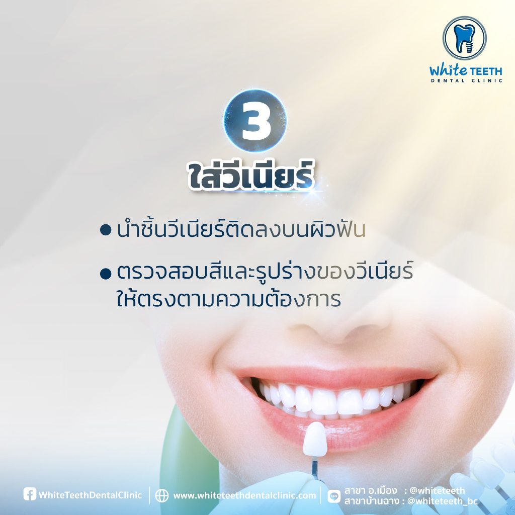 Veneer Procedure-ขั้นตอนการทำวีเนียร์_05 - คลินิกทันตกรรมไวท์ทีธ - White Teeth Dental Clinic