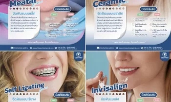 จััดฟัน จัดฟันใส จัดฟันเซรามิก จัดฟันไร้ยาง Invisalign - คลินิกทันตกรรมไวท์ทีธ