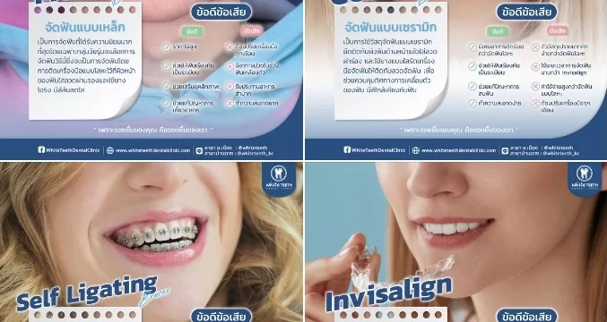 จััดฟัน จัดฟันใส จัดฟันเซรามิก จัดฟันไร้ยาง Invisalign - คลินิกทันตกรรมไวท์ทีธ