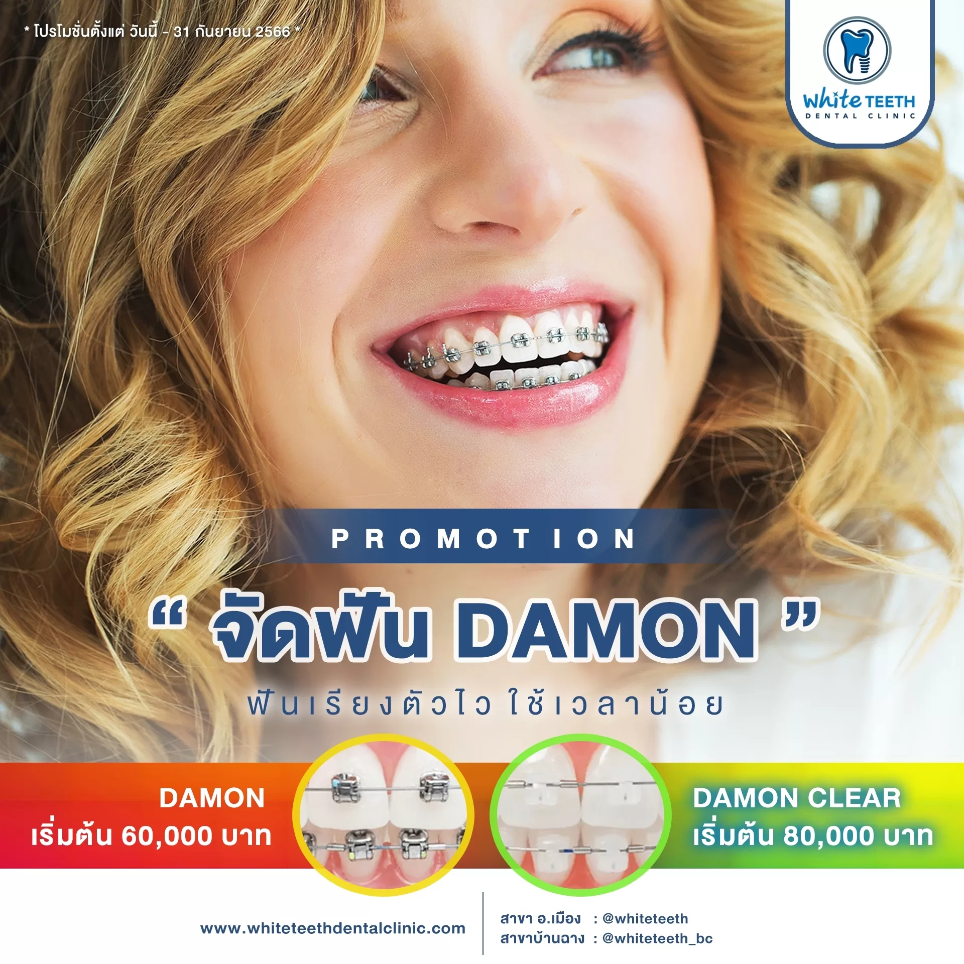 โปรโมชั่น Damon and Damon Clear - คลินิกทันตกรรมไวท์ทีธ