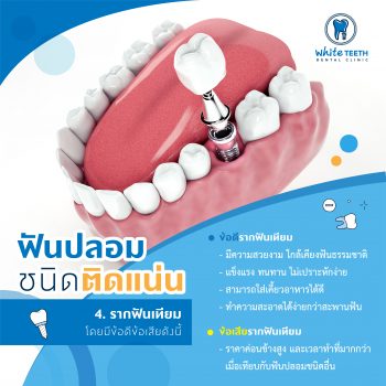 ฟันปลอม (Denture) - คลินิกทันตกรรมไวท์ทีธ (White Teeth Dental Clinic)